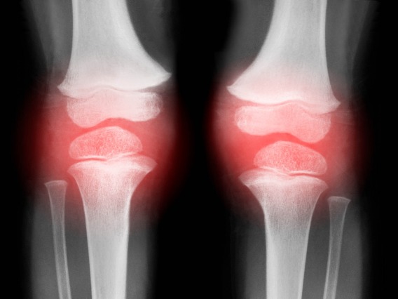 X-ray image of joints with a red cast to suggest inflammation