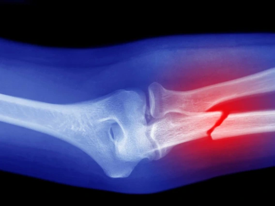 Arm X-Ray