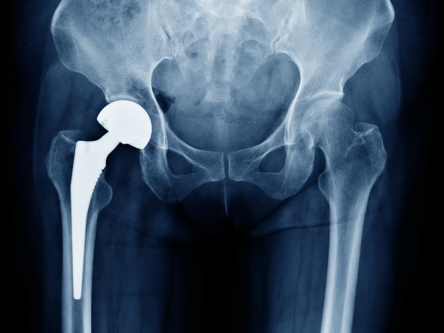 Hip Replacement X-ray