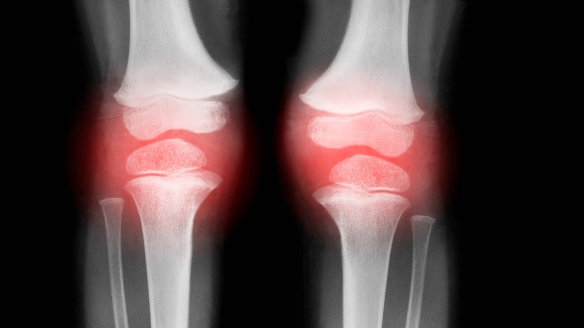 X-ray image of joints with a red cast to suggest inflammation